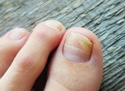 Fungal Nail